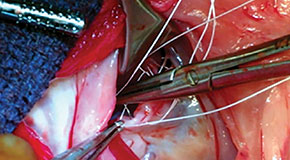 Mitral valve repair surgery in dogs - The future is exciting